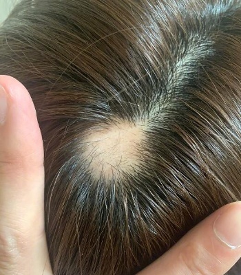 沈梦辰晒斑秃照片引热议 2026年斑秃能自愈吗 斑秃原因及日常护理全解析