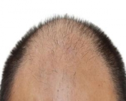 ֲ����Ḵ���� 2026��ֲ����ȫ�� ֲ��Ч�������� ë�ҳɻ��ʸ��� ����ҽԺֲ��������
